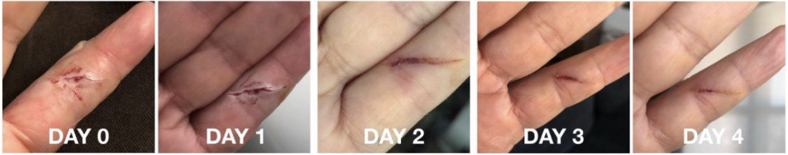 finger-4days