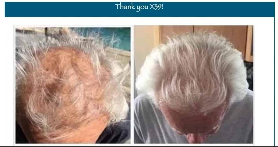 hair loss restore x39